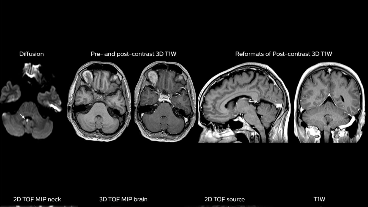Head-neck MRI including MR angiography