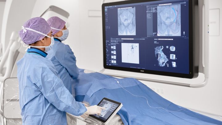 Prostate artery embolization