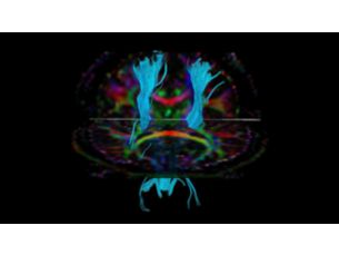 DTI FiberTrak MR Clinical application