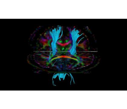 Philips - DTI FiberTrak MRクリニカルアプリケーション