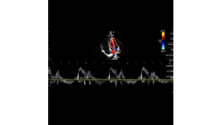 Pulsed wave Doppler with steerable color functionality