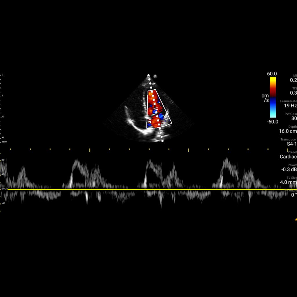 PW Doppler -steerable col. fun