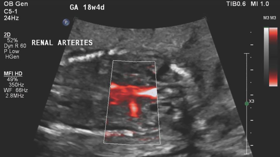 Figure 3 C5-1 transducer sagittal image of the left renal artery using MFI-HD