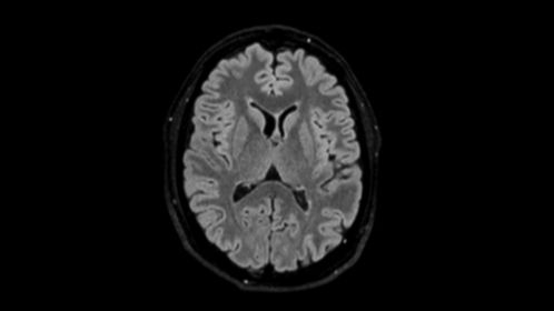 Axial Reformat 3D BrainVIEW FLAIR