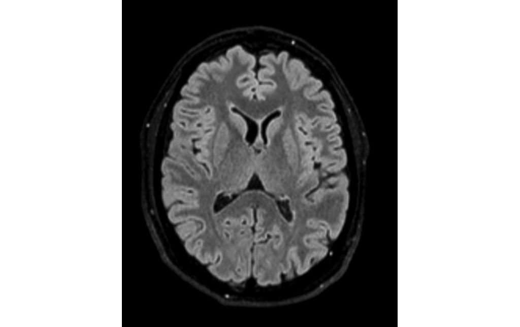Axial Reformat 3D BrainVIEW FLAIR