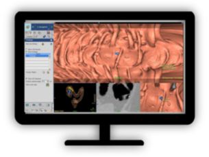 ​CT Virtual Colonoscopy Reducing reading times(1) in virtual colonoscopy