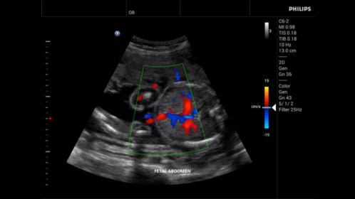 Innosight clinical image fetal abdomen