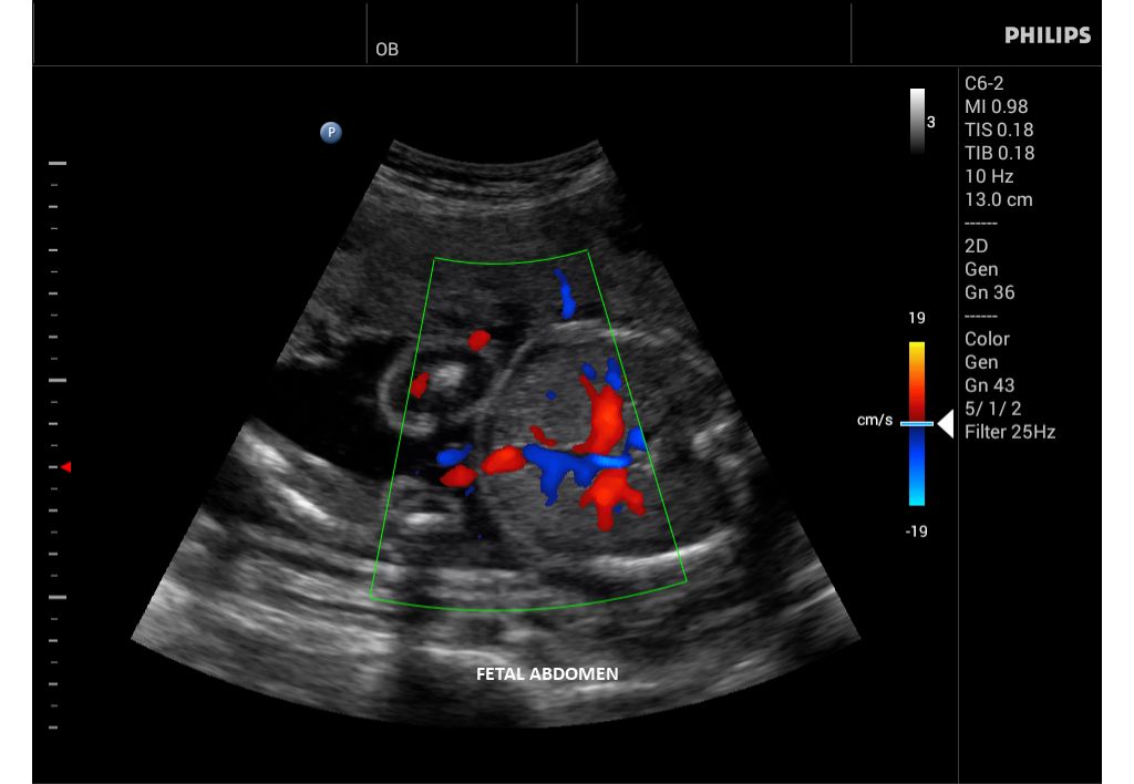Innosight clinical image fetal abdomen