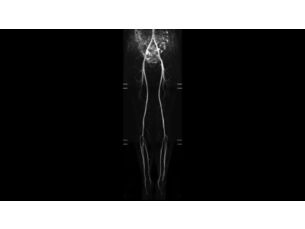 Compressed SENSE - Vascular MR Clinical Applications