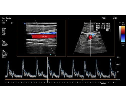 Carotid with PulseWave Doppler