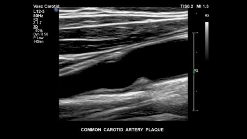 EPIQ ultrasound machine clinical image common carotid artery plaque