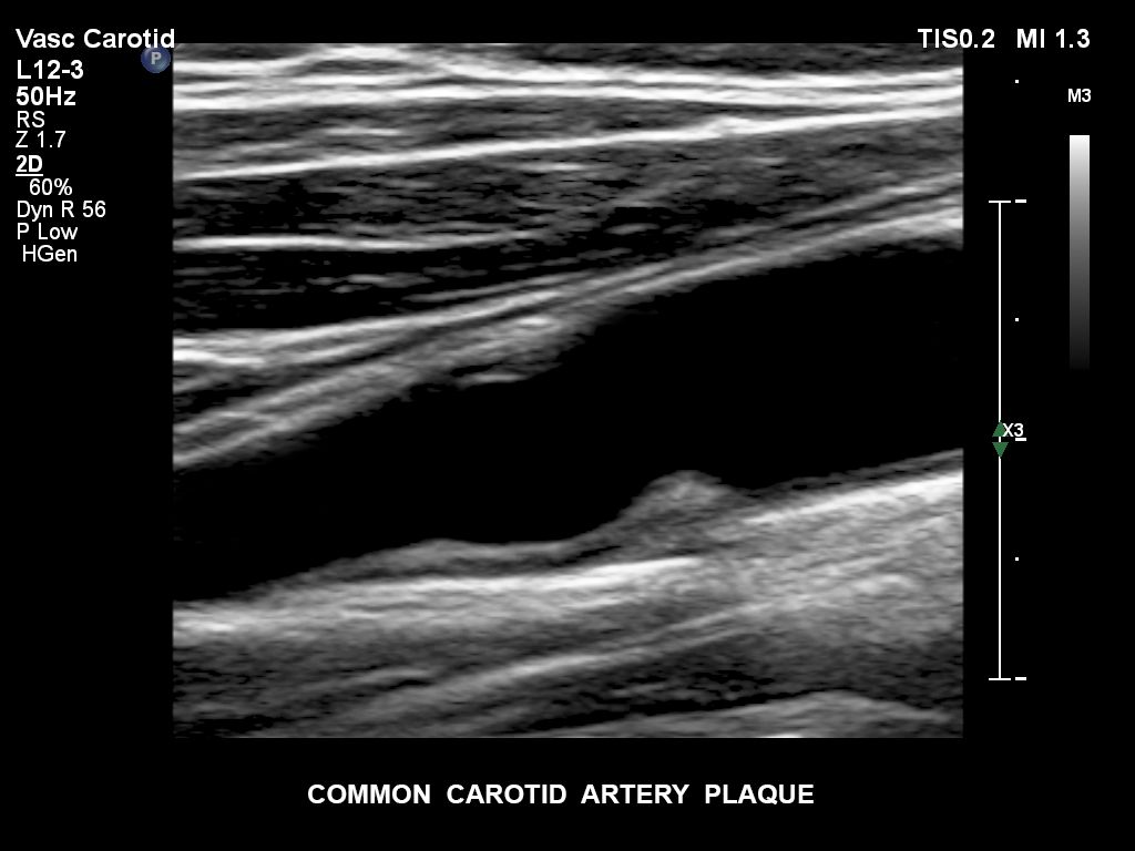 EPIQ ultrasound machine clinical image common carotid artery plaque