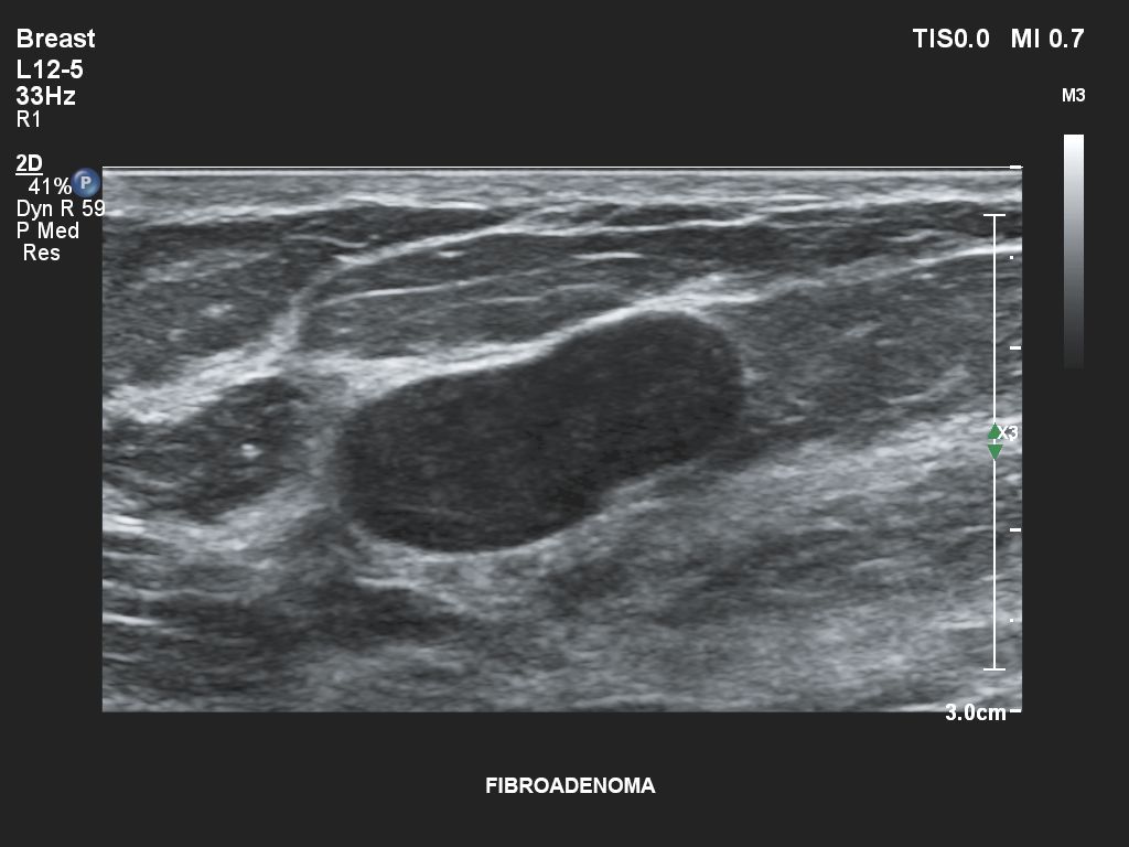 Affiniti 30 ultrasound clinical image breast fibroadenoma 