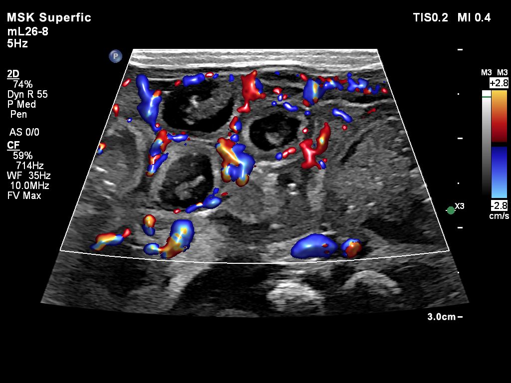 MSK Superfic Bowel FV