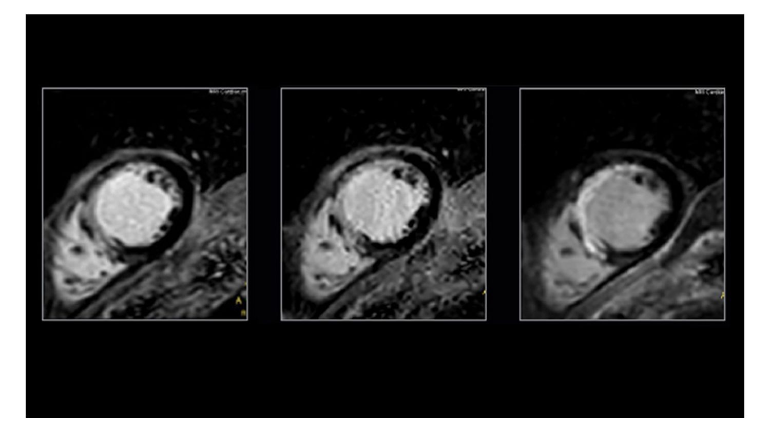 Free-breathing single-shot cardiac MRI with Compressed SENSE 