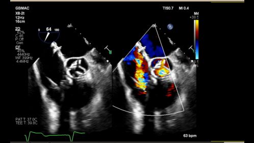 EPIQ X8-2t Color Compare Triscuspid and Aortic Valve
