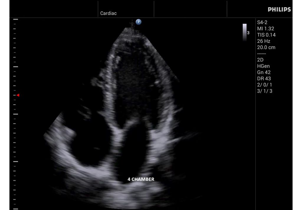 InnoSight clinical image four chamber