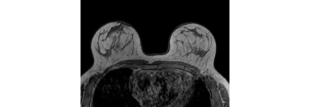 Axial T1w FFE 3D (FlexTrak Mammo 7ch)