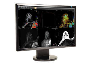 DynaCAD Breast Advanced visualization for breast MRI analysis