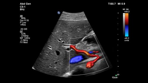 C5-1 Abdomen, with Flow Viewer