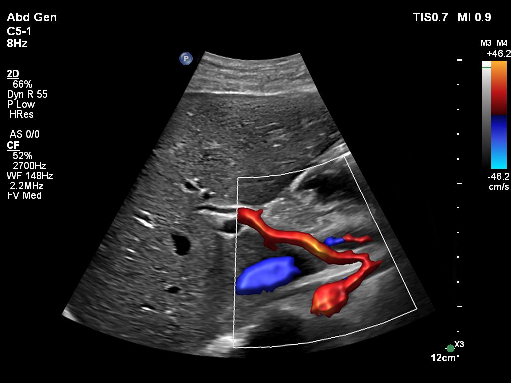C5-1 paired with Flow Viewer, scanning on the Pediatric Abdomen
