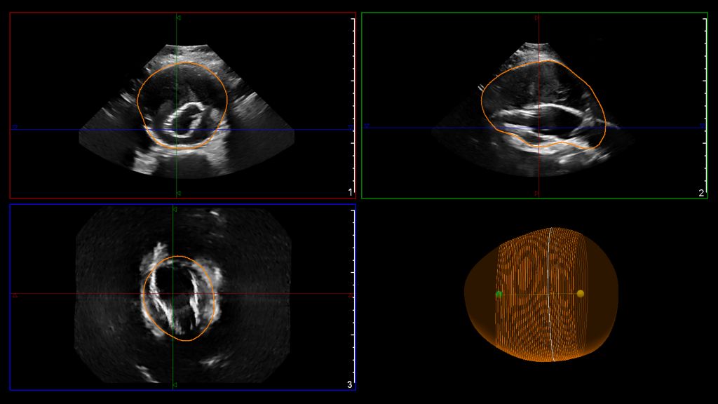 EPIQ utilizing the X6-1 transducer for the Philips AAA model