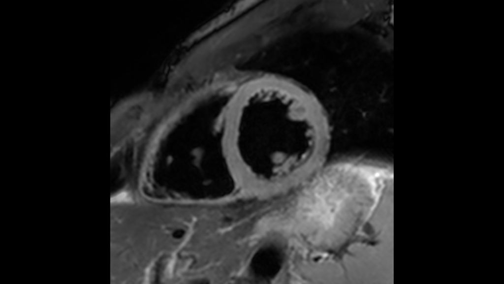 Black Blood imaging