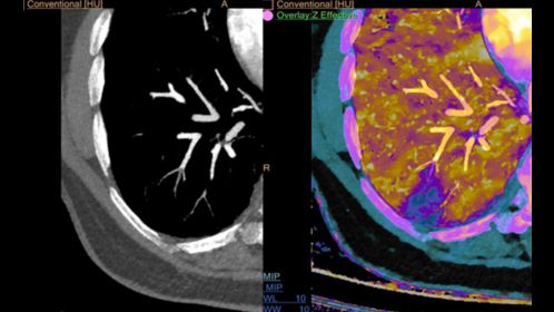 Lower Right Lung PE