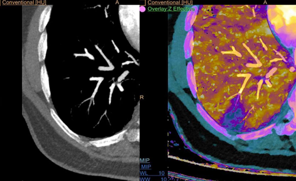 Lower Right Lung PE