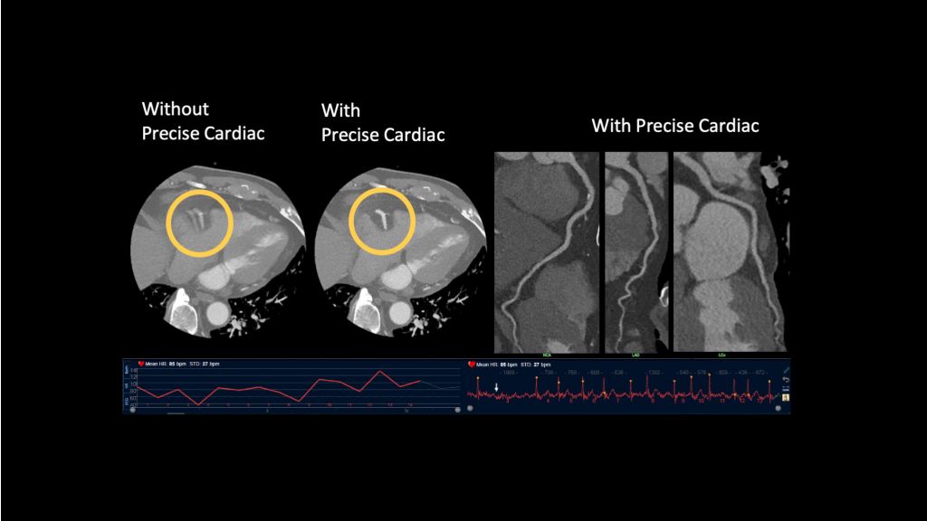 AI-enabled Precise Image enhances image quality in cardiac scans
