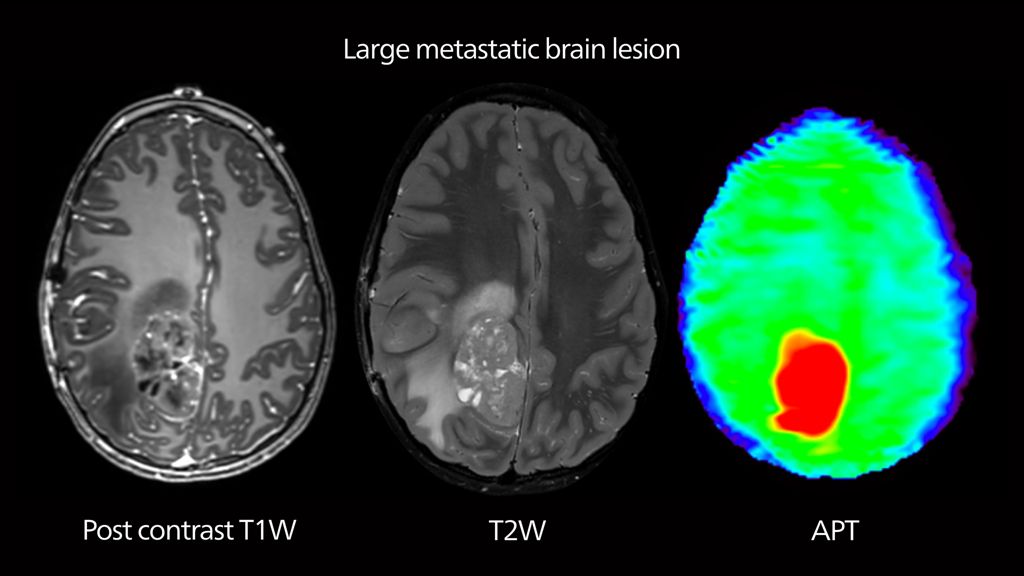 Brain APT MRI 