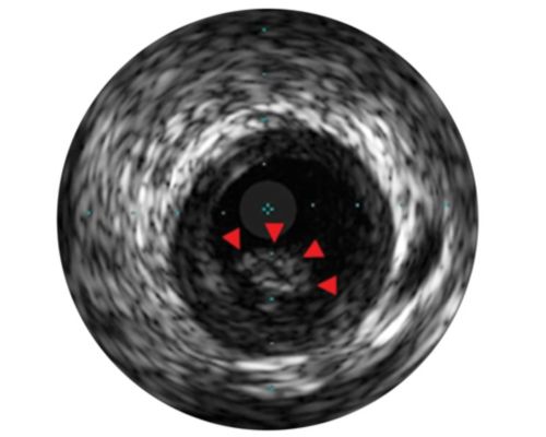 Disease diagnosis using Philips IVUS technology