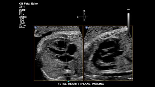 Fetal heart. xPlane Imaging