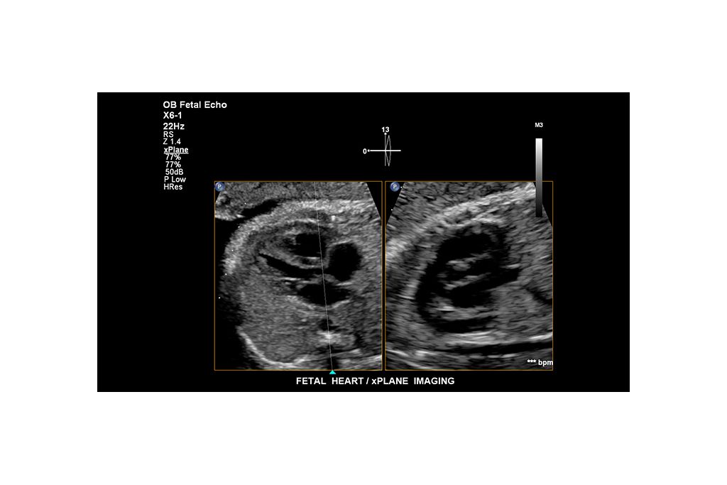 Fetal heart. xPlane Imaging