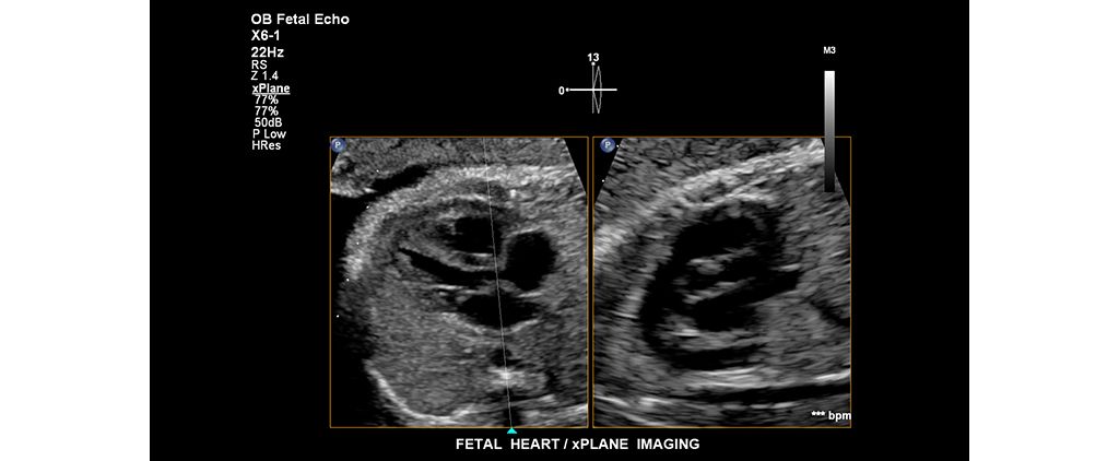 Fetal heart. xPlane Imaging