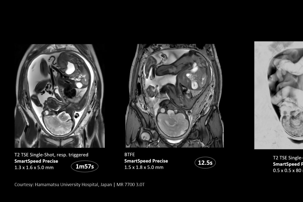 SmartSpeed Precise - Up to 3 times faster imaging. Preserve details in shorter scan times. Powered by Dual AI. 
Compared to Philips SENSE imaging. Dual AI: Reconstruction technology consisting of a first AI engine applied at the source of signal (Adaptive CS-NET) and a second AI engine applied on the raw complex imaging data (Precise Image Net).
