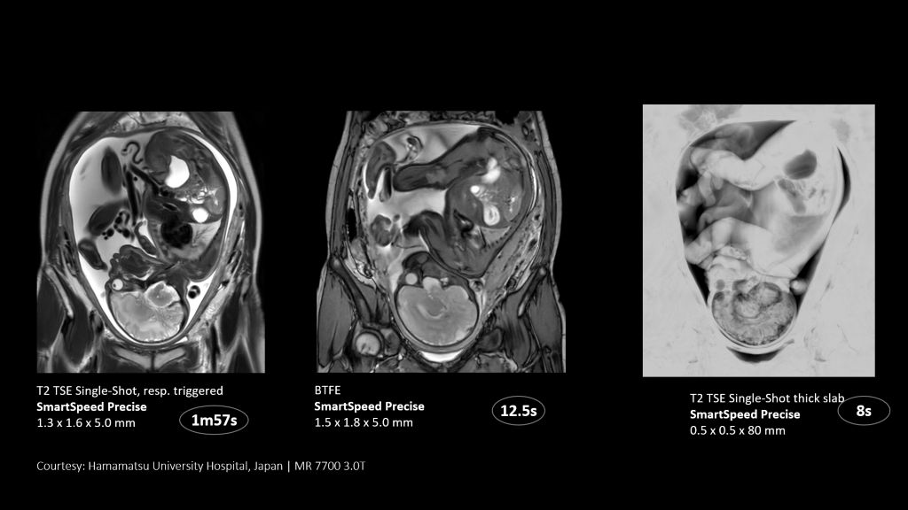 SmartSpeed Precise - Up to 3 times faster imaging. Preserve details in shorter scan times. Powered by Dual AI. 
Compared to Philips SENSE imaging. Dual AI: Reconstruction technology consisting of a first AI engine applied at the source of signal (Adaptive CS-NET) and a second AI engine applied on the raw complex imaging data (Precise Image Net).
