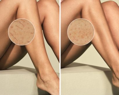 Visible results after only 2 treatments⁶