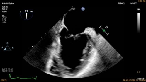 2D TEE of Left Ventricle