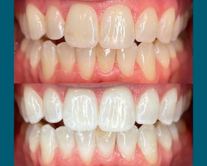 A comparison of teeth pre- and post whitening.