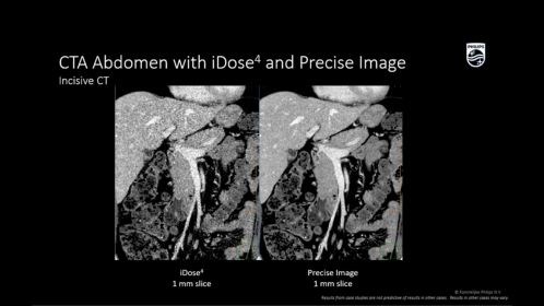 Incisive CT Angiographie par TDM abdomen avec iDose4 et Precise Image