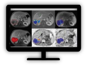 Multi Modality Tumor Tracking qEASL​ Semi-automatic tumor quantification​