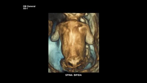 Spina Bifida