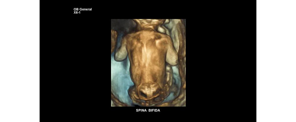 Spina Bifida