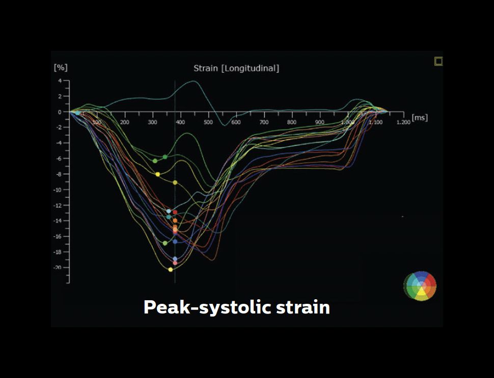 AutoStrain Clinical image showing segmental strain curves and strain values – peak systolic strain