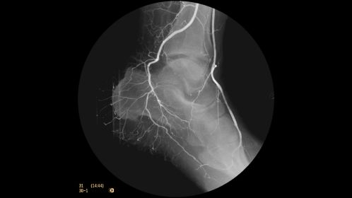 Clinical Image Philips BV Mobile C-arm Pulsera