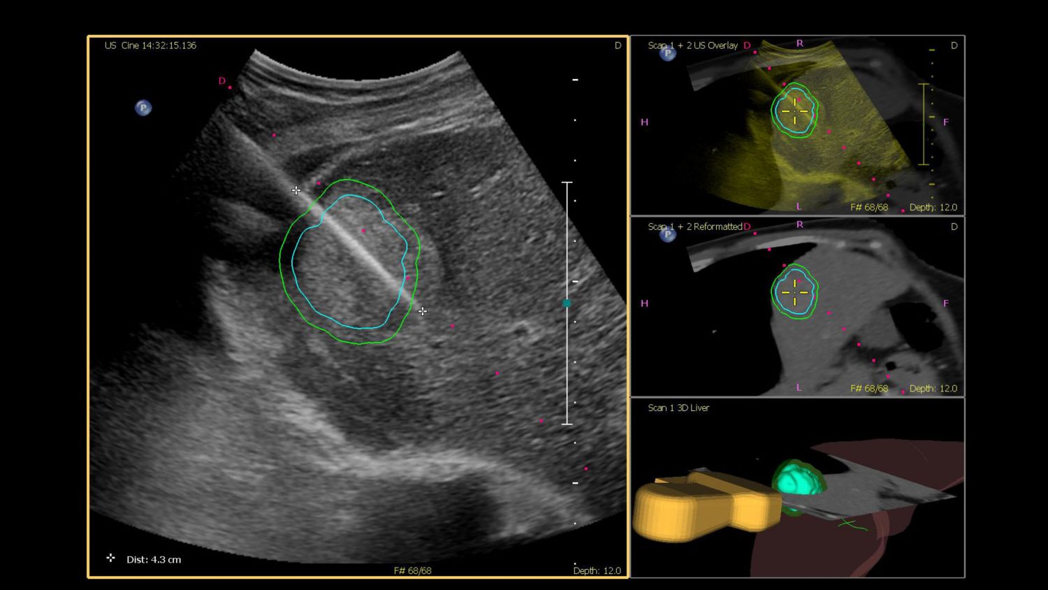 Tumor Contour Fusion Navigation