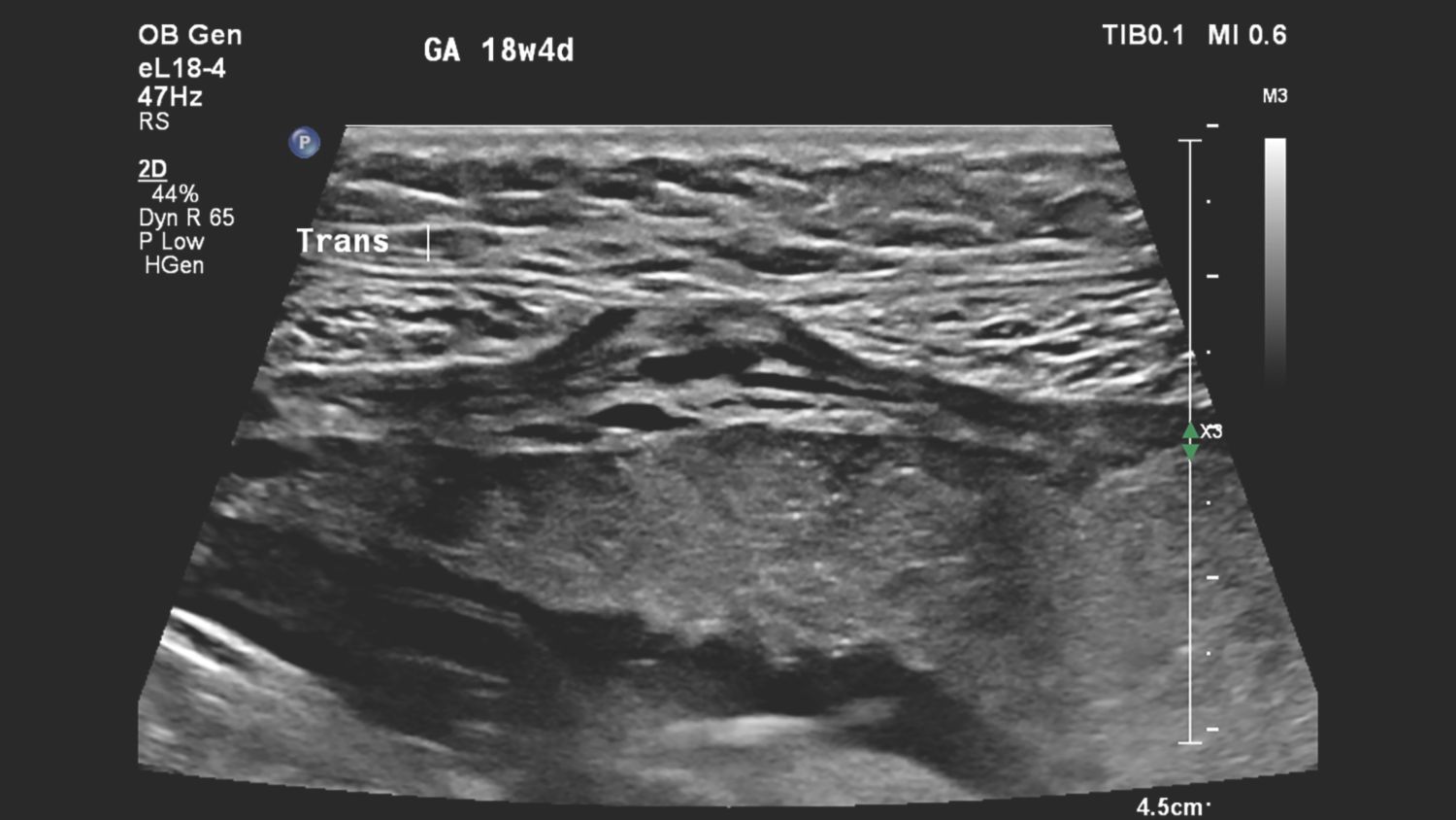 Figure 5 eL18-4 transducer close-up of the suspected placental abnormality