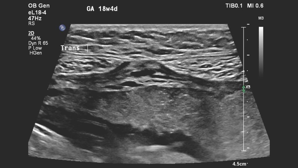 Figure 5 eL18-4 transducer close-up of the suspected placental abnormality