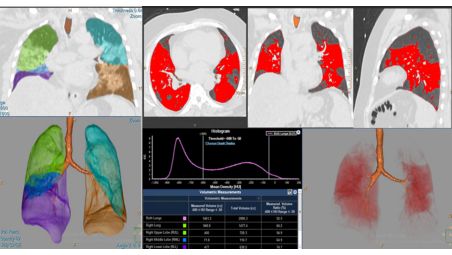 Advanced quantification of affected lung volumes​